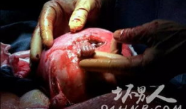 刨腹产视频,直观呈现母婴安全守护